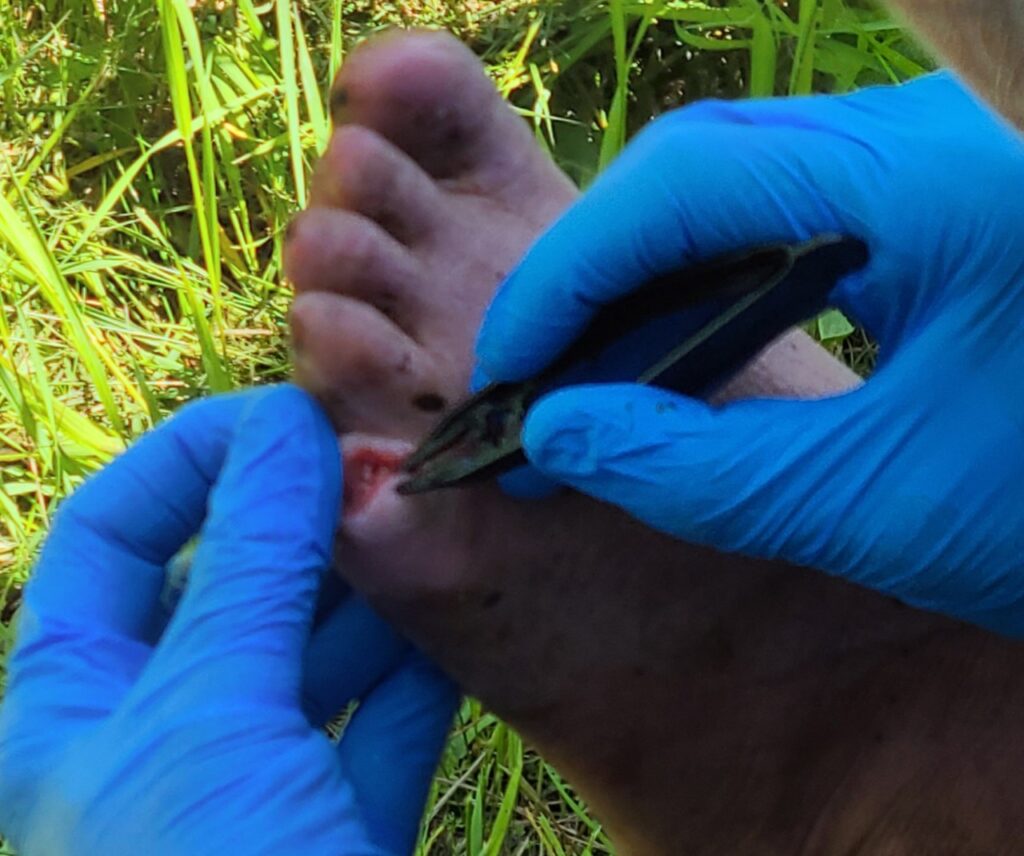 Maggots Invade A Homeless Friends Foot IMFK